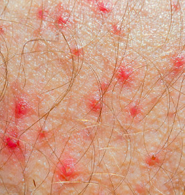 Understanding Clusters of Itchy Red Bumps on the Skin